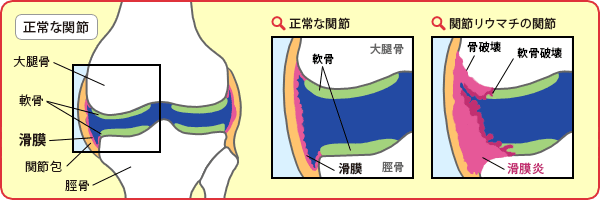 正常な関節